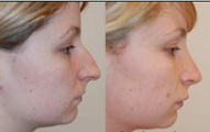 Rhinoplasty and Lip Enhancement with Silikon-1000
