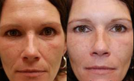Silikon-1000 for wrinkle reduction