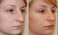 Rhinoplasty and Lip Augmentation with Silikon-1000