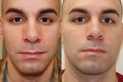 Lower Eyelid Rejuvenation with Silikon-1000