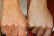 Hand Rejuvenation with Silikon-1000