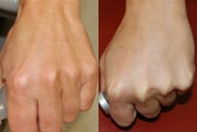 Hand Rejuvenation with Silikon-1000