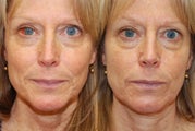 Non-Surgical Facial Rejuvenation with Silikon-1000