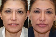 Non-Surgical Facial Rejuvenation with Silikon-1000: eyelids, lips, cheeks, acne scarring, nasolabial folds. 3 treatments.
