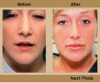 Lip Augmentation