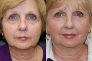 Non-Surgical Facial Rejuvenation with Silikon-1000 and Botox Cosmetic.