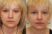 Non-Surgical Facial Rejuvenation with Silikon-1000