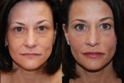 Non-Surgical Facial Rejuvenation with Silikon-1000. 2 treatments.