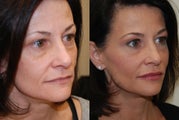 Non-Surgical Facial Rejuvenation with Silikon-1000. 2 treatments.
