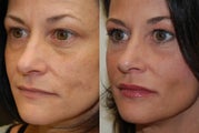 Non-Surgical Facial Rejuvenation with Silikon-1000. 2 treatments.