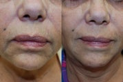 Perioral Rejuvenation with Silikon-1000: Minimizing tha "bar-code"