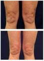 Body Laser Skin Tightening - Legs