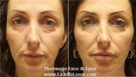 Thermage skin tightening for face and eyes