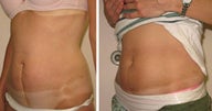 C-section scar revision with excision and SlimLipo