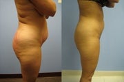 SmartLipo Triplex 
