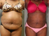 37 Year old Female Loses 14" Upper Lower Abs