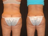 Smart Lipo