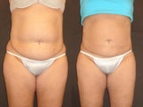 SmartLipo