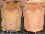 SmartLipo