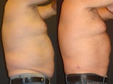 SmartLipo