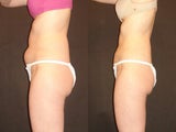 SmartLipo