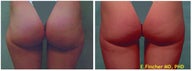 Liposuction / Smartlipo
