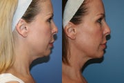 SmartLipo MPX