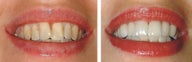 Smile makeover