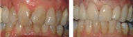 Veneers for an older patient