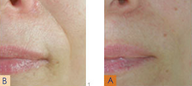 Juvederm