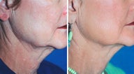 Titan Neck Treatment