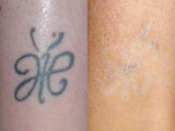 Laser Tattoo Removal