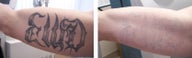 Laser tattoo removal