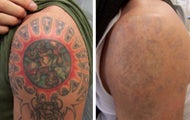Laser tattoo removal