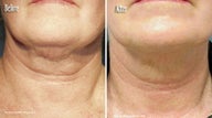  Thermage to Neck, chin  and jaw line