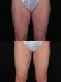 Medial thigh lift