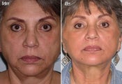 Threadlift to full face