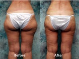 Inner and outer thigh liposuction
