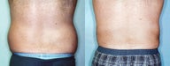 Male Stomach & Love Handles Lipo