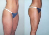 Liposuction (Thighs, Knees & Buttocks)