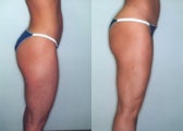 Liposuction (Thighs, Knees & Buttocks)