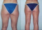 Liposuction (Thighs, Knees & Buttocks)