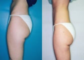 Liposuction of Posterolateral/Medial Thigh ('Saddlebags')