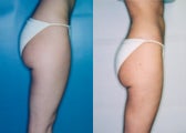 Liposuction of Posterolateral/Medial Thigh ('Saddlebags')