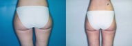 Liposuction of Posterolateral/Medial Thigh ('Saddlebags')