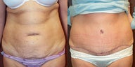 Tummy Tuck