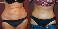 Tummy Tuck