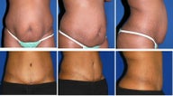 Tummy tuck abdominoplasty
