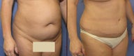 Tummy Tuck