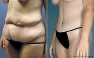 Tummy Tuck